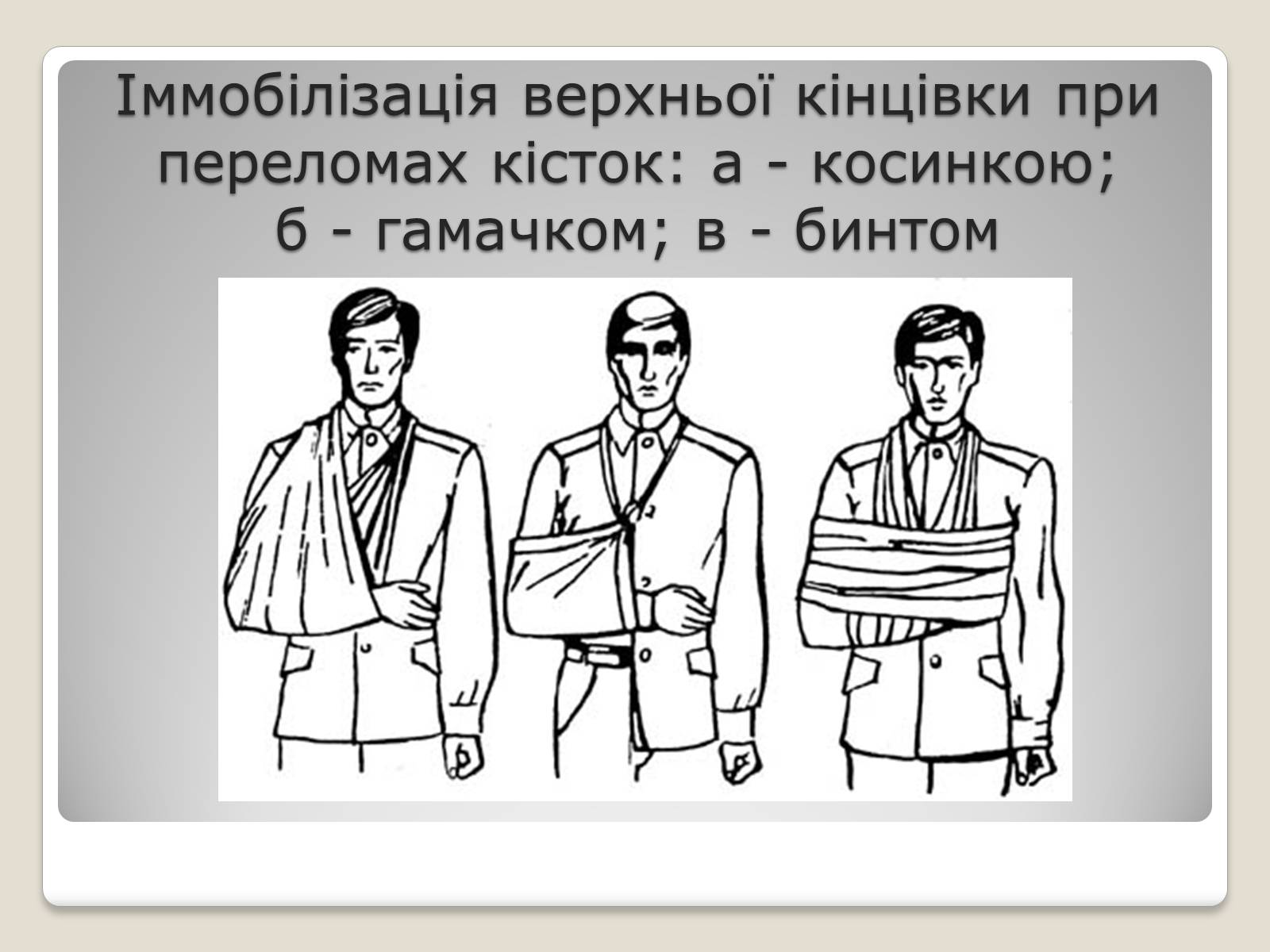 Презентація на тему «Іммобілізація ушкодженої ділянки тіла» - Слайд #3