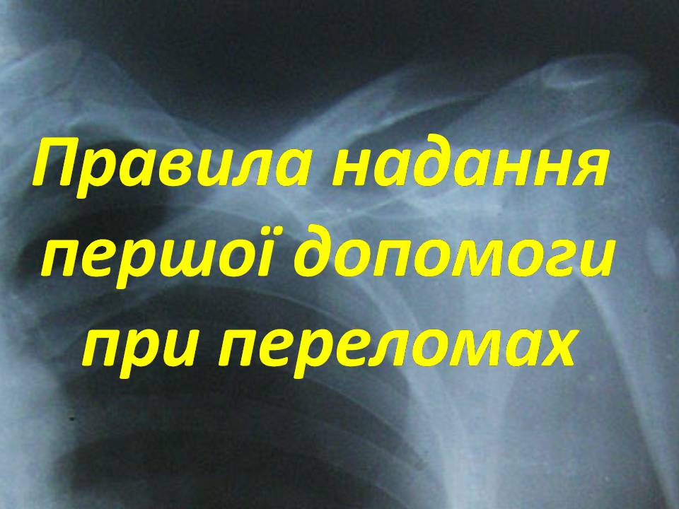 Презентація на тему «Правила надання першої допомоги ?при переломах» - Слайд #2
