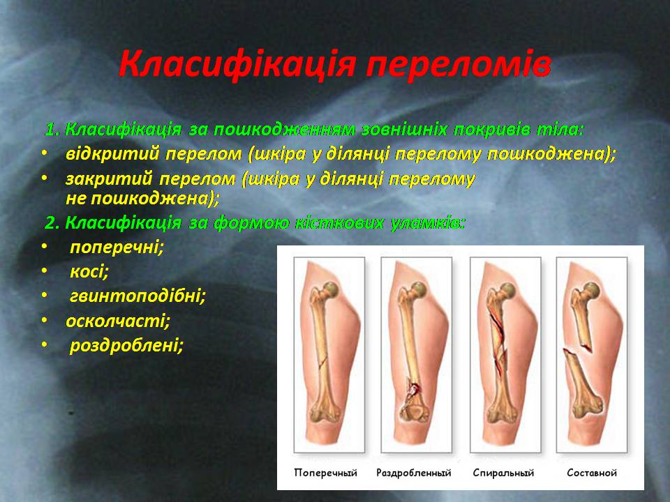 Презентація на тему «Правила надання першої допомоги ?при переломах» - Слайд #5