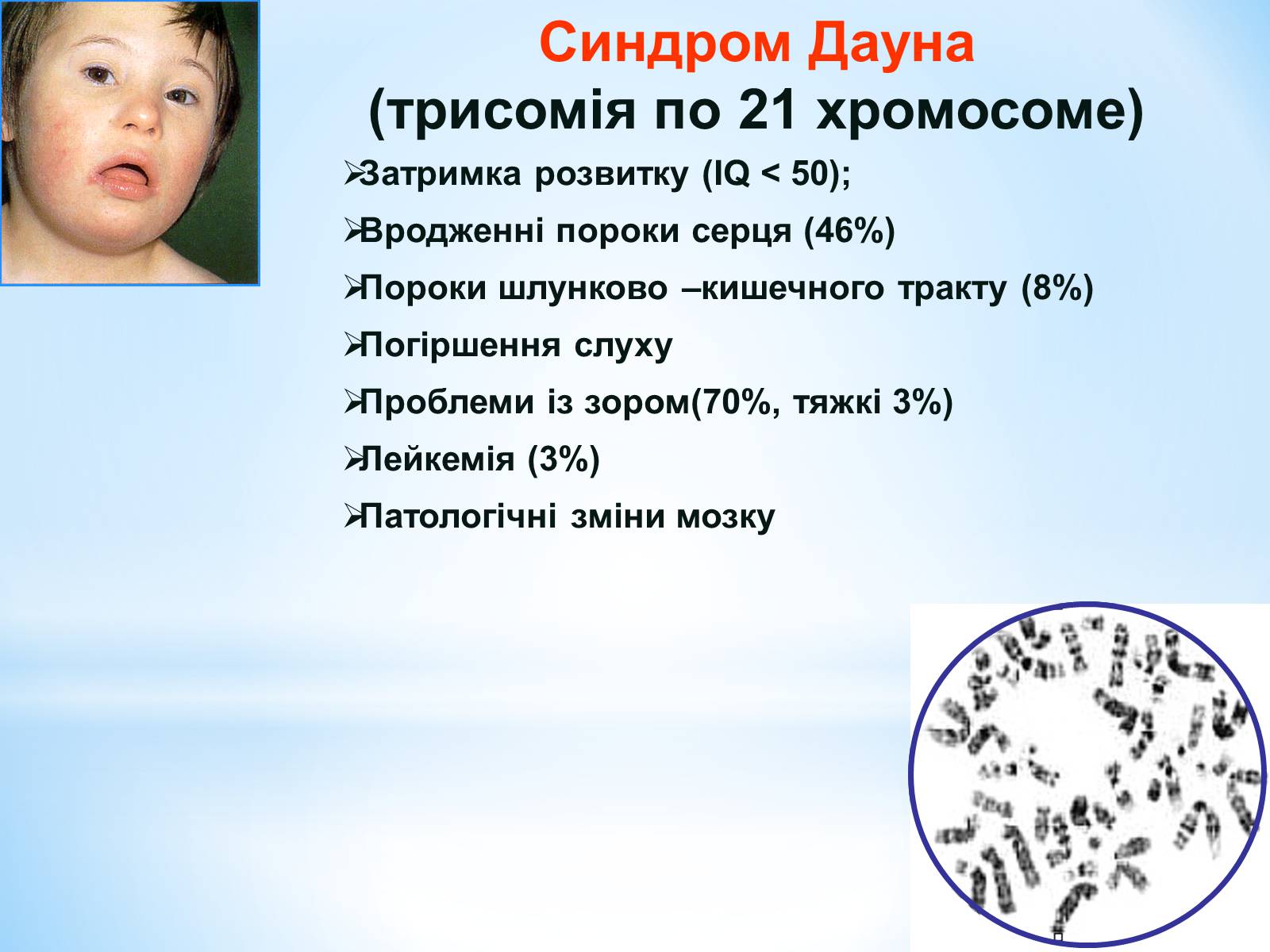 Синдром дауна лишняя хромосома. Синдром Дауна. Синдром Дауна хромосомы. Синдром Дауна трисомия. Синдром Дауна трисомия 21 хромосомы.
