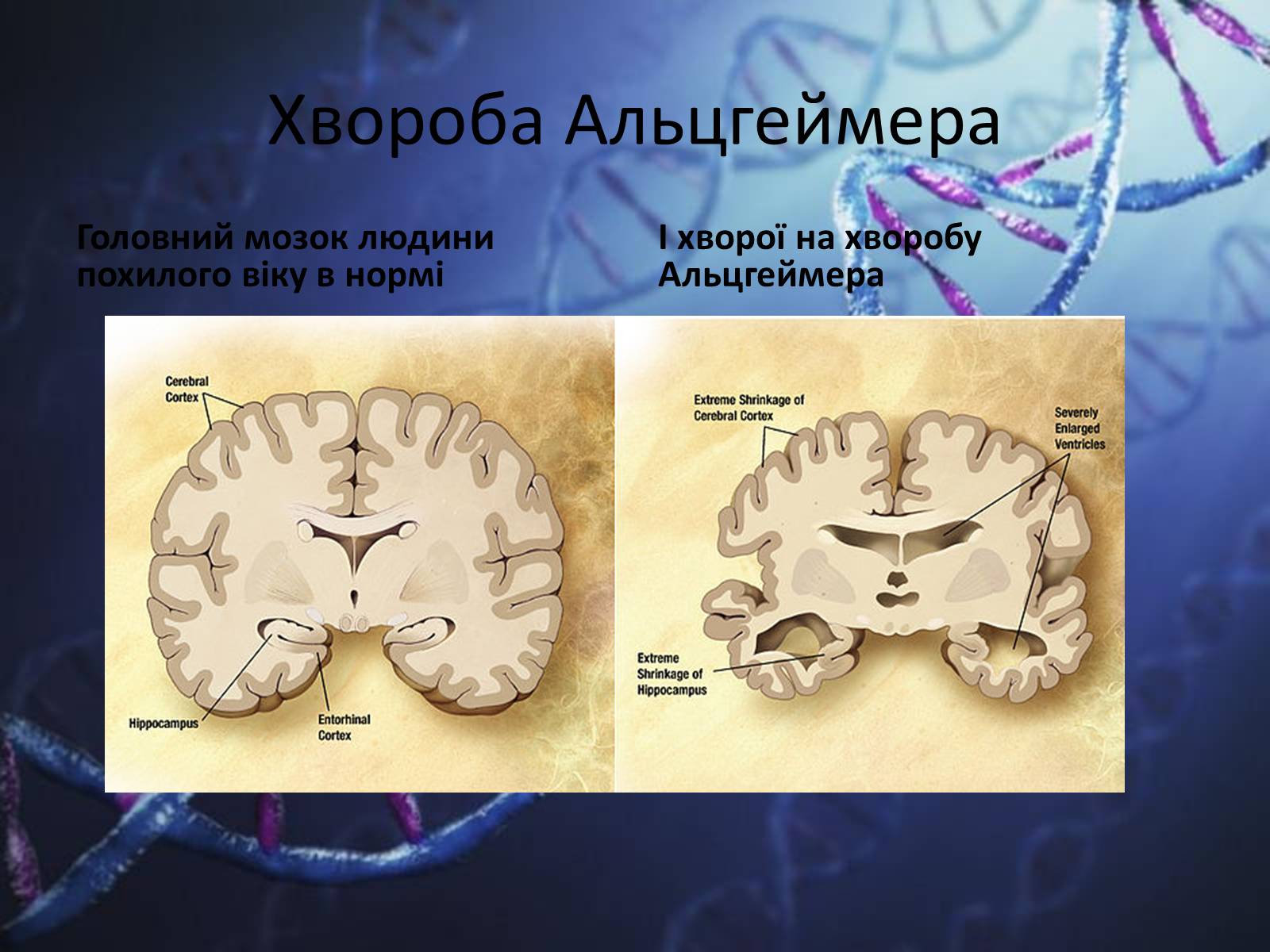 Презентація на тему «Генетичні захворювання людини» - Слайд #10