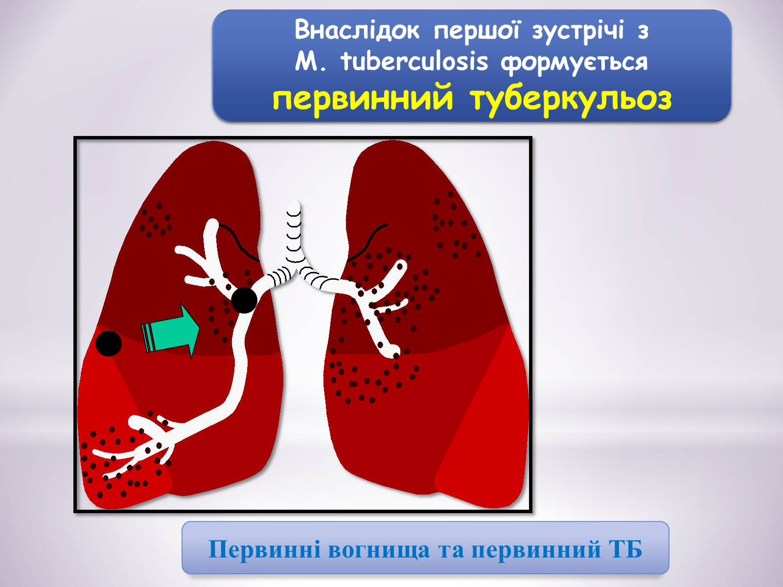 Презентація на тему «Туберкульоз» (варіант 6) - Слайд #4