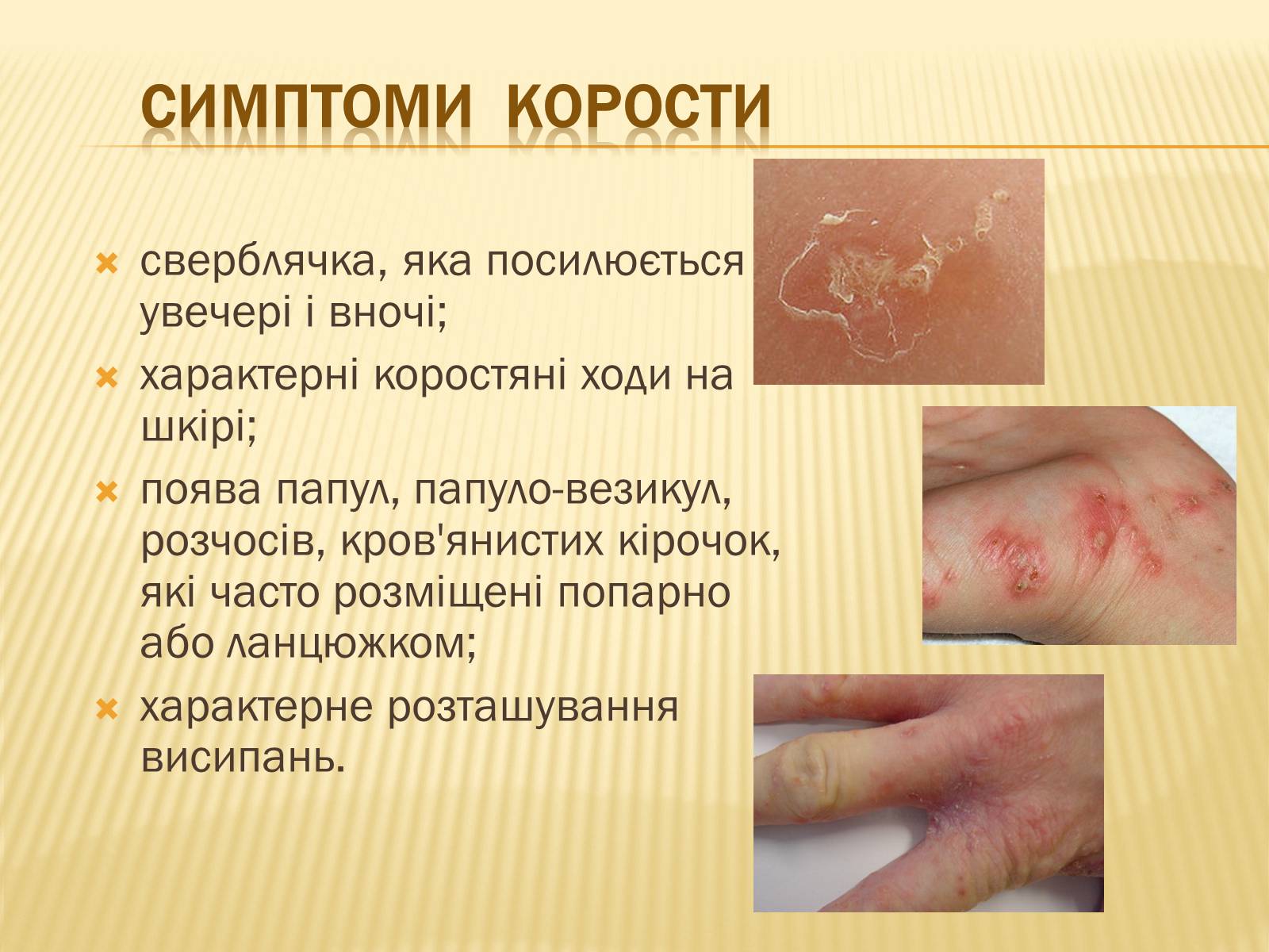 Презентація на тему «Хвороби шкіри» - Слайд #18