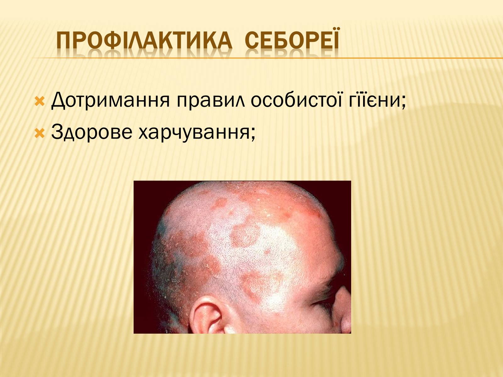 Презентація на тему «Хвороби шкіри» - Слайд #23