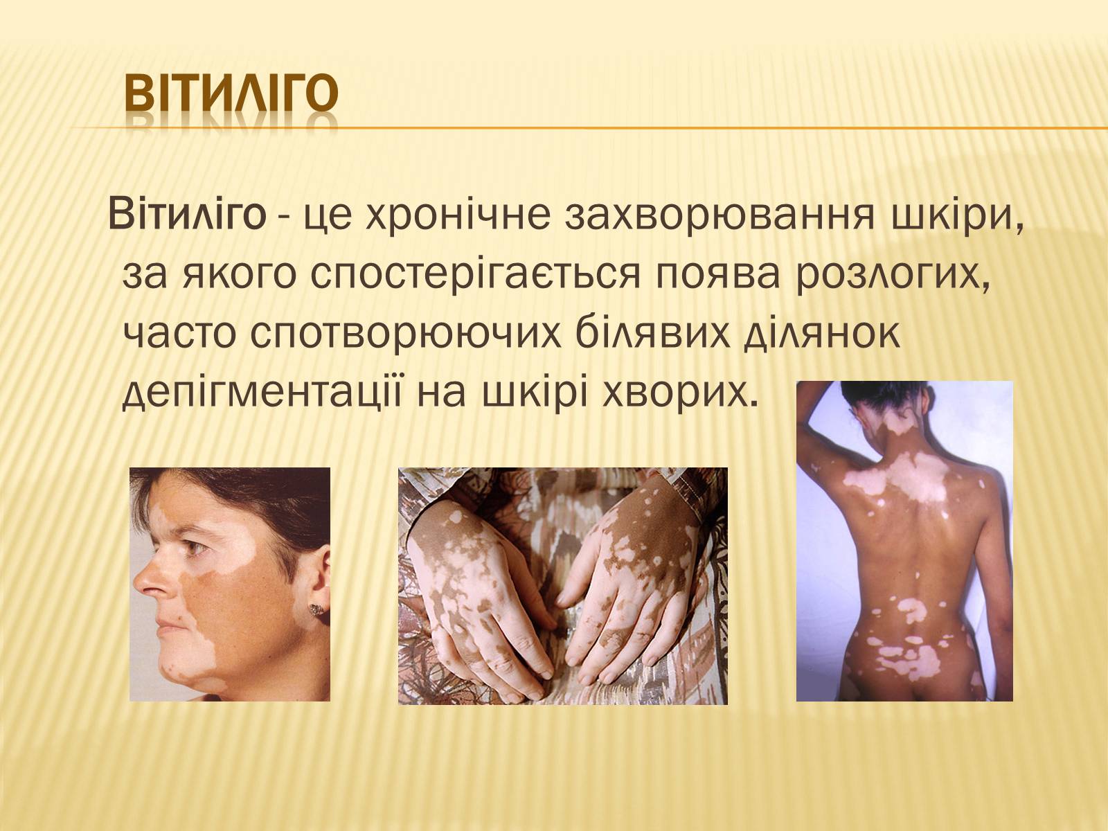 Презентація на тему «Хвороби шкіри» - Слайд #7
