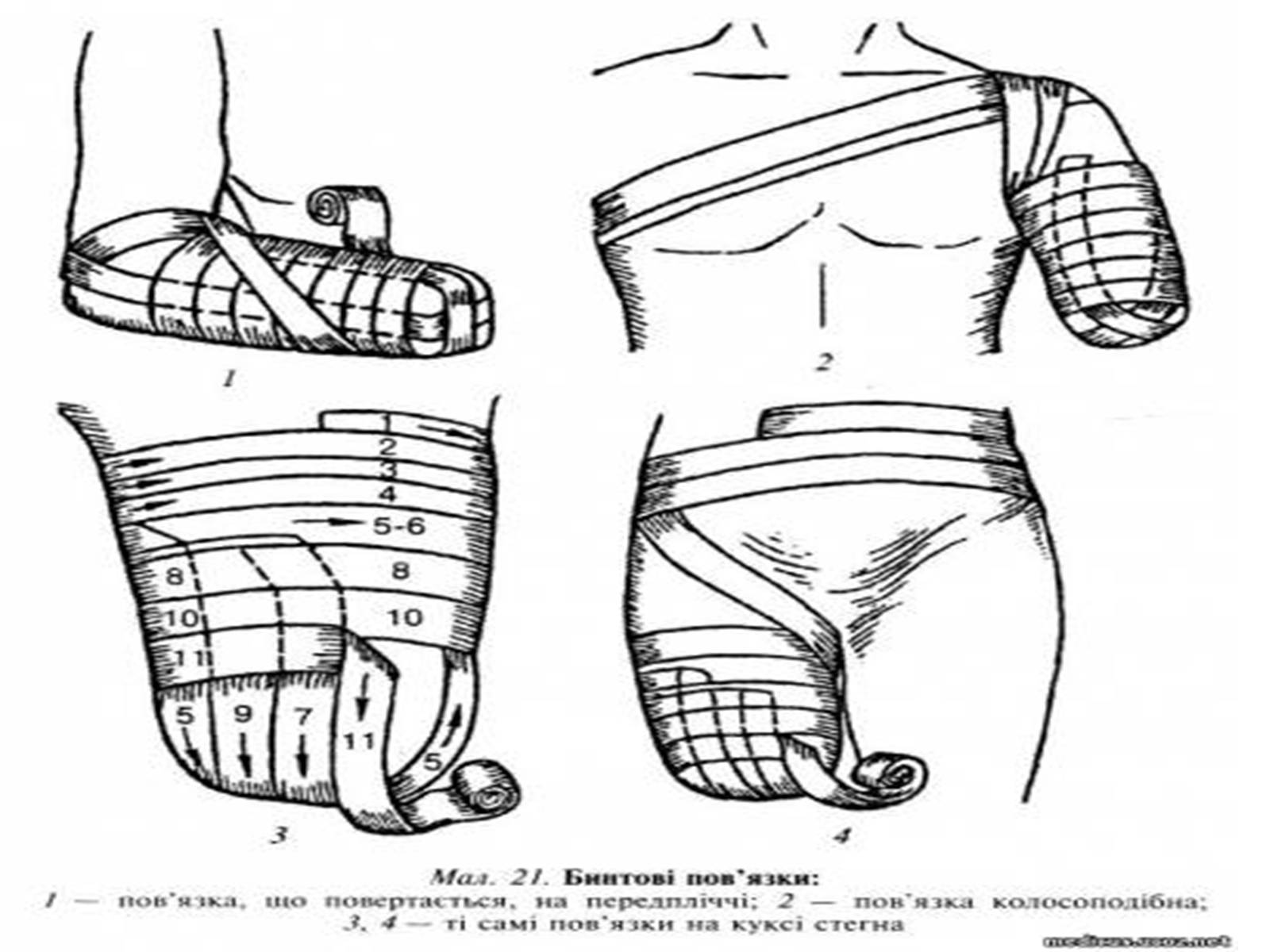 Презентація на тему «Накладання пов&#8217;язок» - Слайд #21