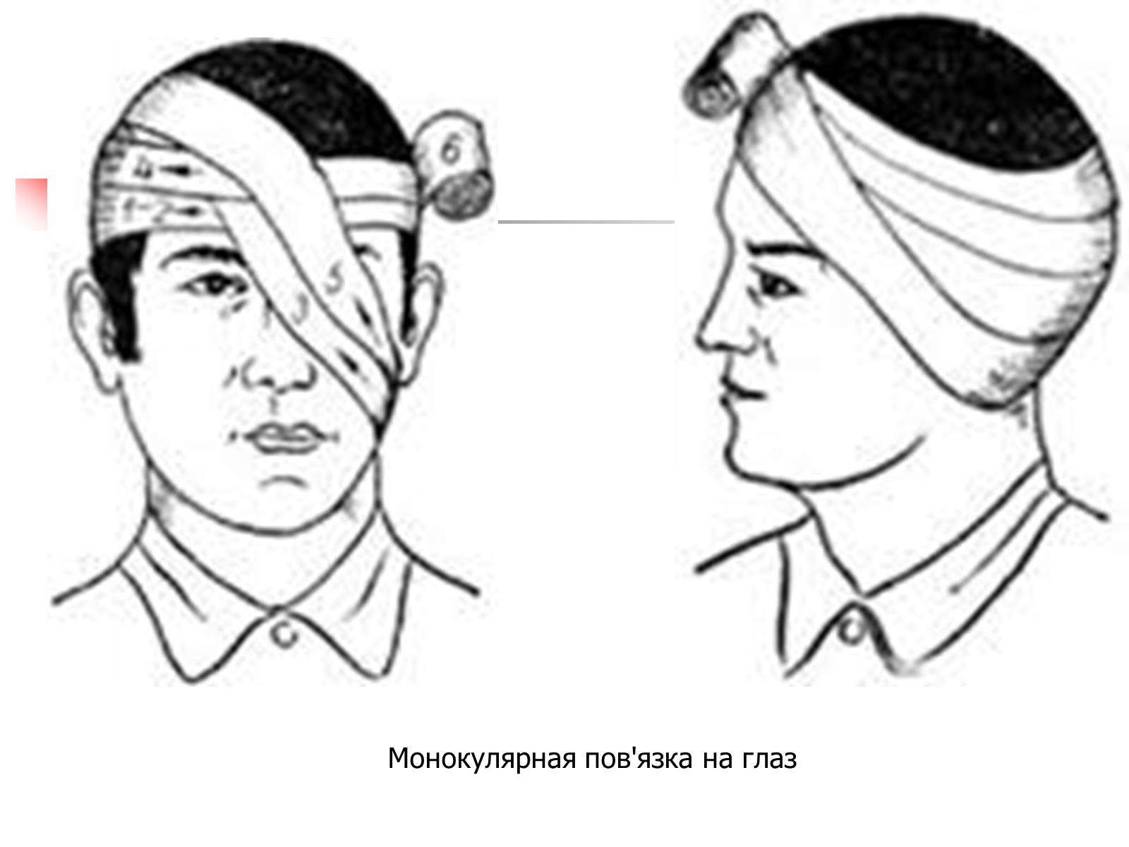 Повязка алгоритм. Наложение повязки на один глаз монокулярная. Повязка на ухо. Повязка на глаз при травме.