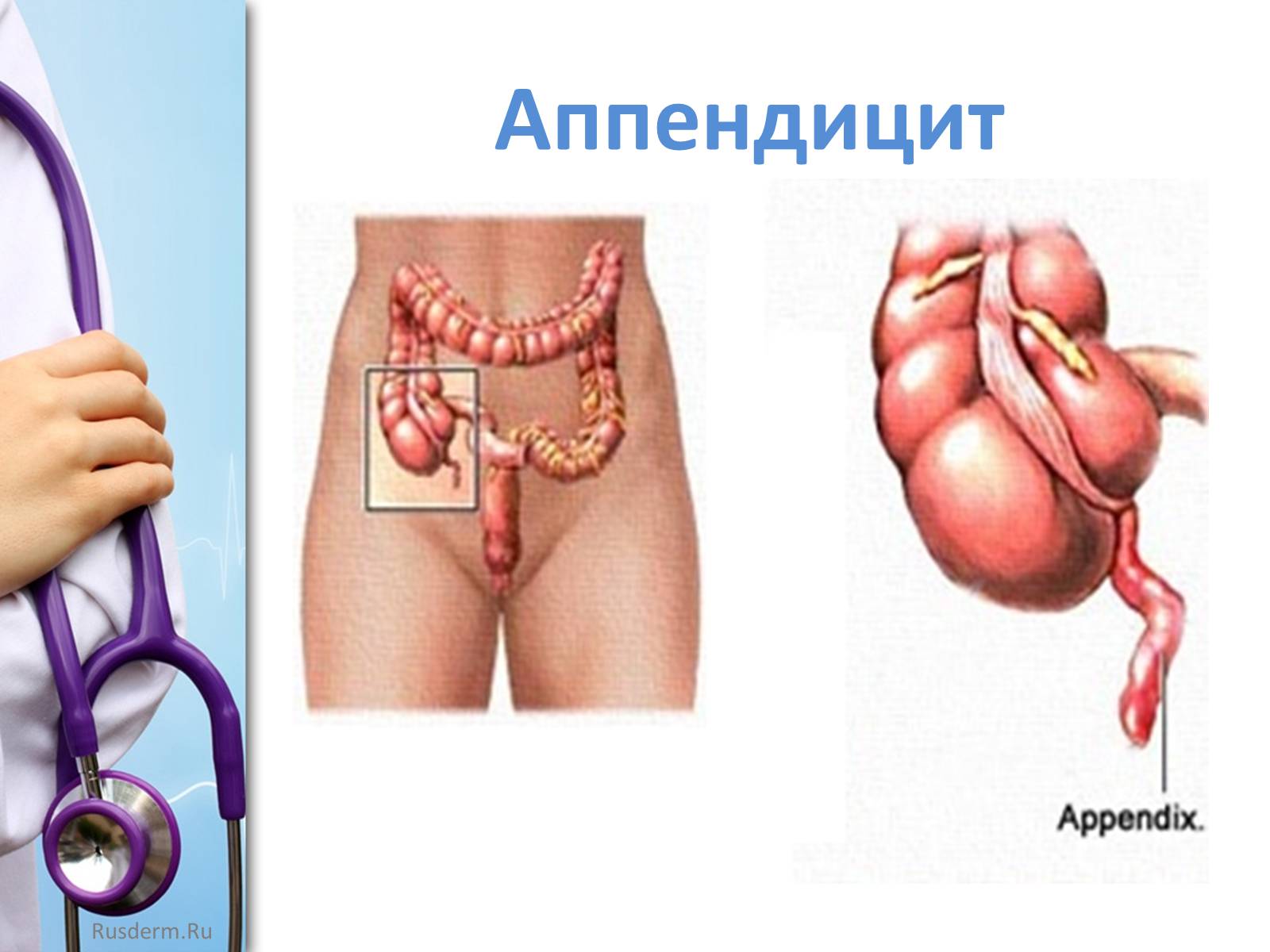 Где находится аппендицит у человека. Где находится аппендицит.