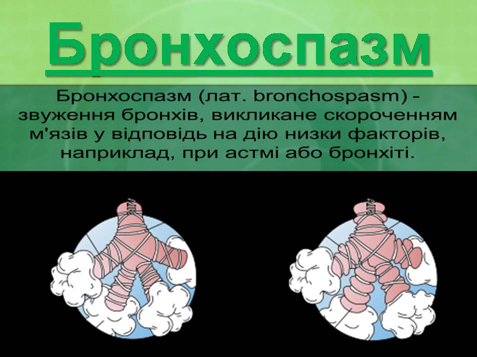 Презентація на тему «Бронхіальна астма» - Слайд #4