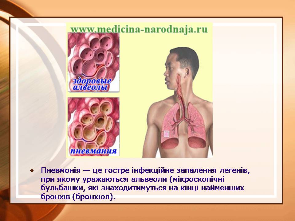 Презентація на тему «Пневмонія» - Слайд #2