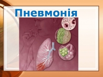 Презентація на тему «Пневмонія»