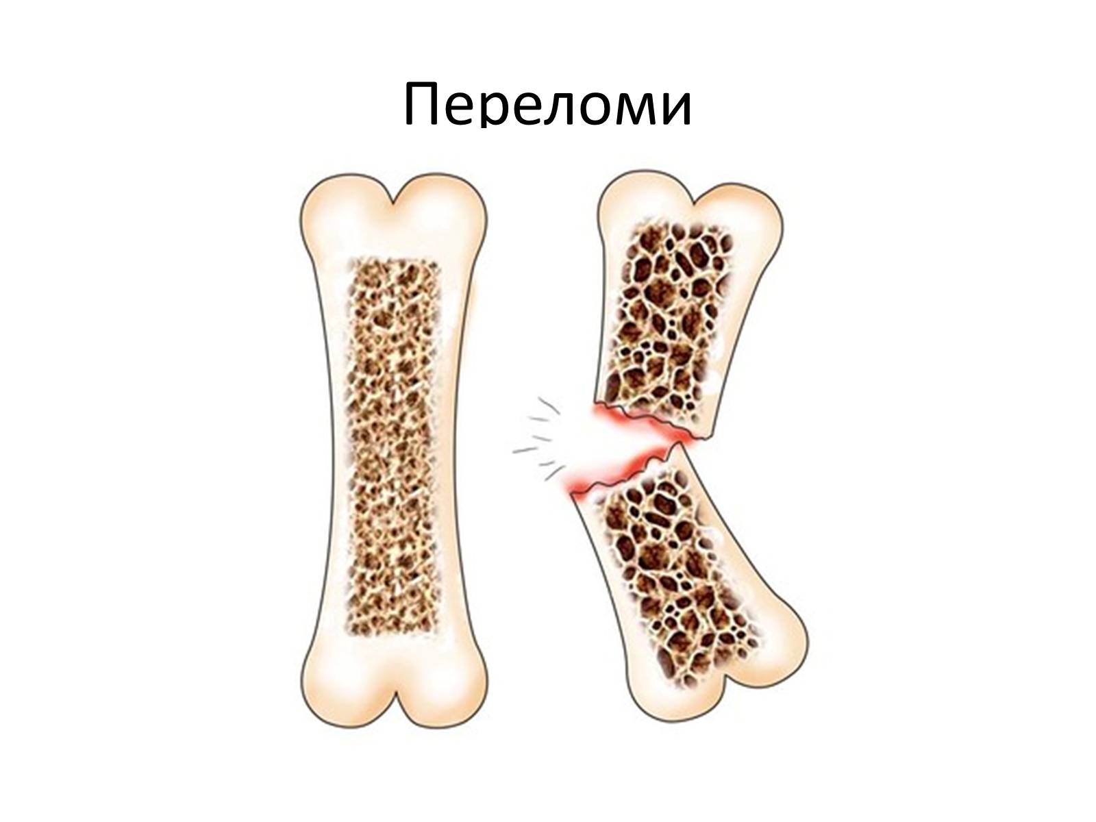 Презентація на тему «Переломи та вивихи. Перша допомога» - Слайд #10