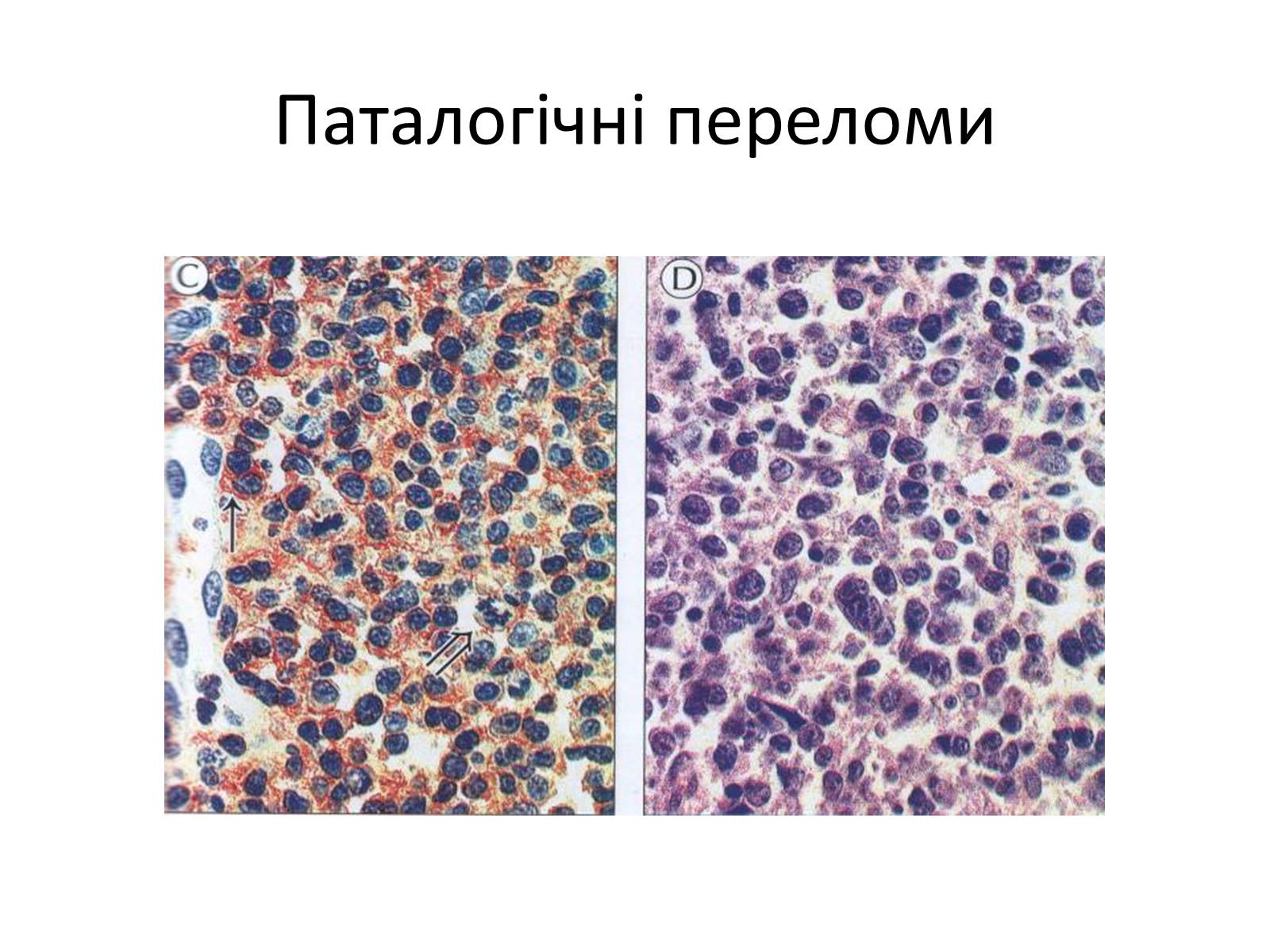 Презентація на тему «Переломи та вивихи. Перша допомога» - Слайд #14