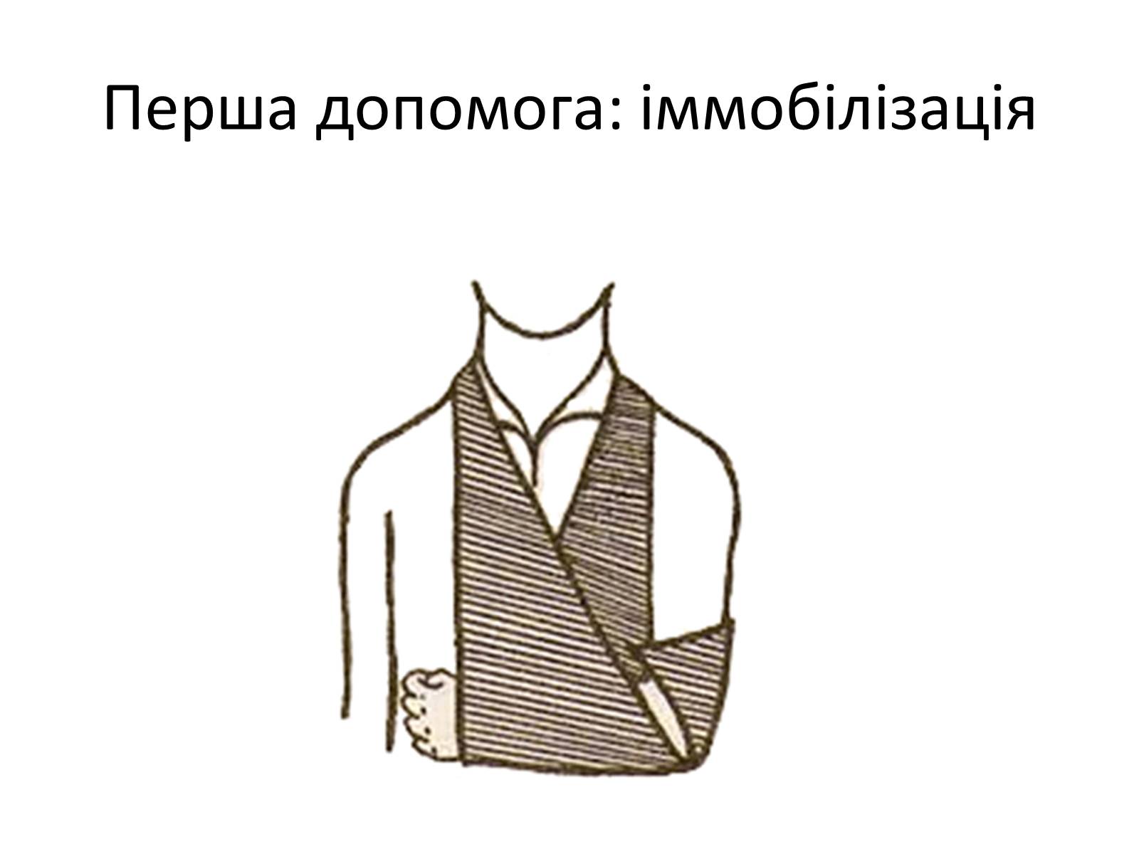 Презентація на тему «Переломи та вивихи. Перша допомога» - Слайд #15