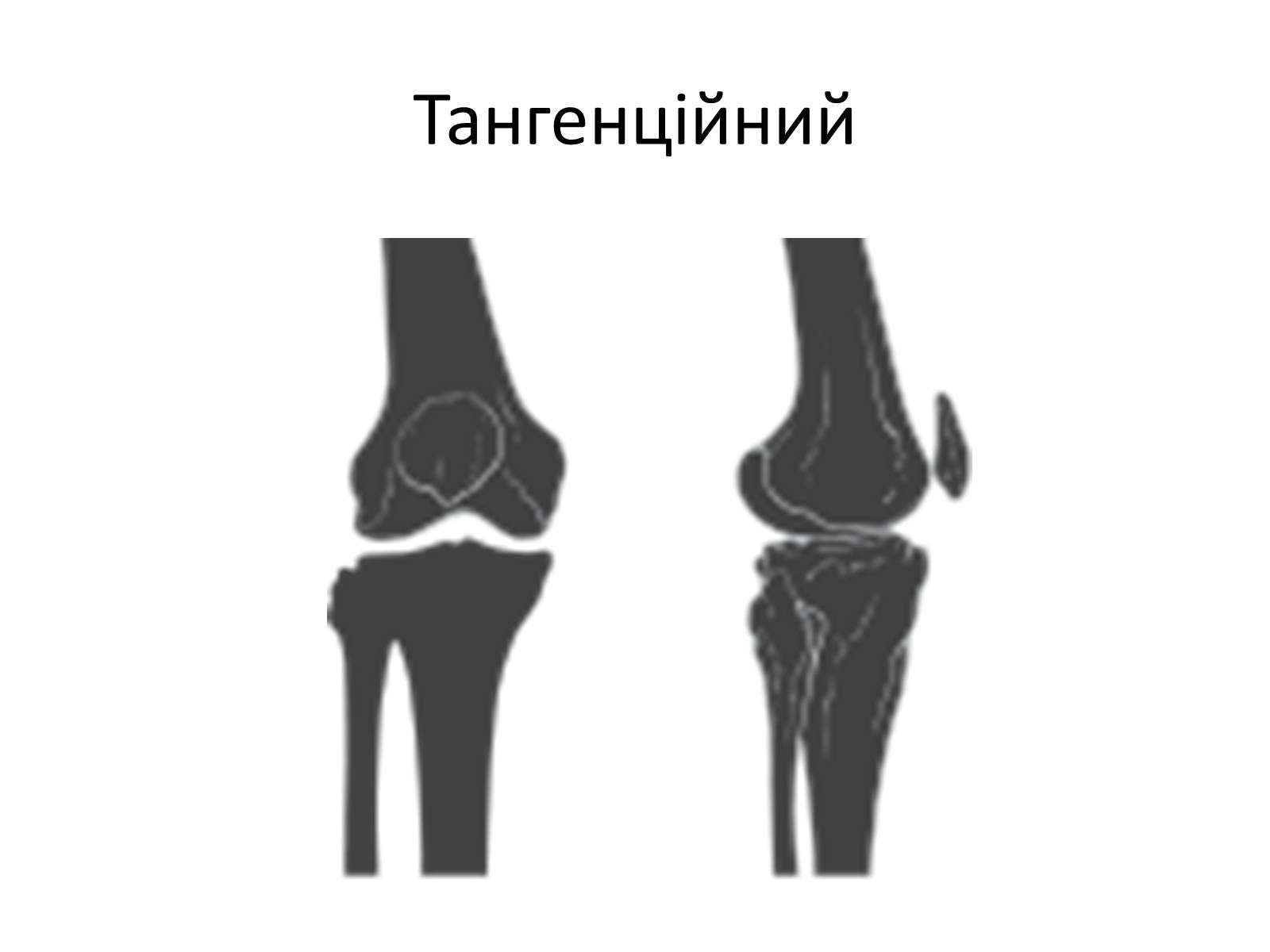 Презентація на тему «Переломи та вивихи. Перша допомога» - Слайд #5