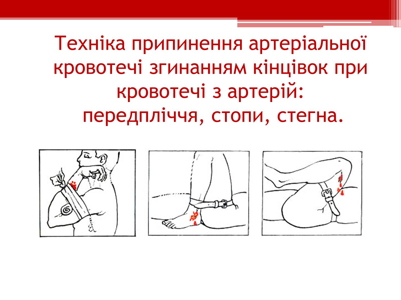 Презентація на тему «Перша допомога при кровотечах» (варіант 1) - Слайд #12