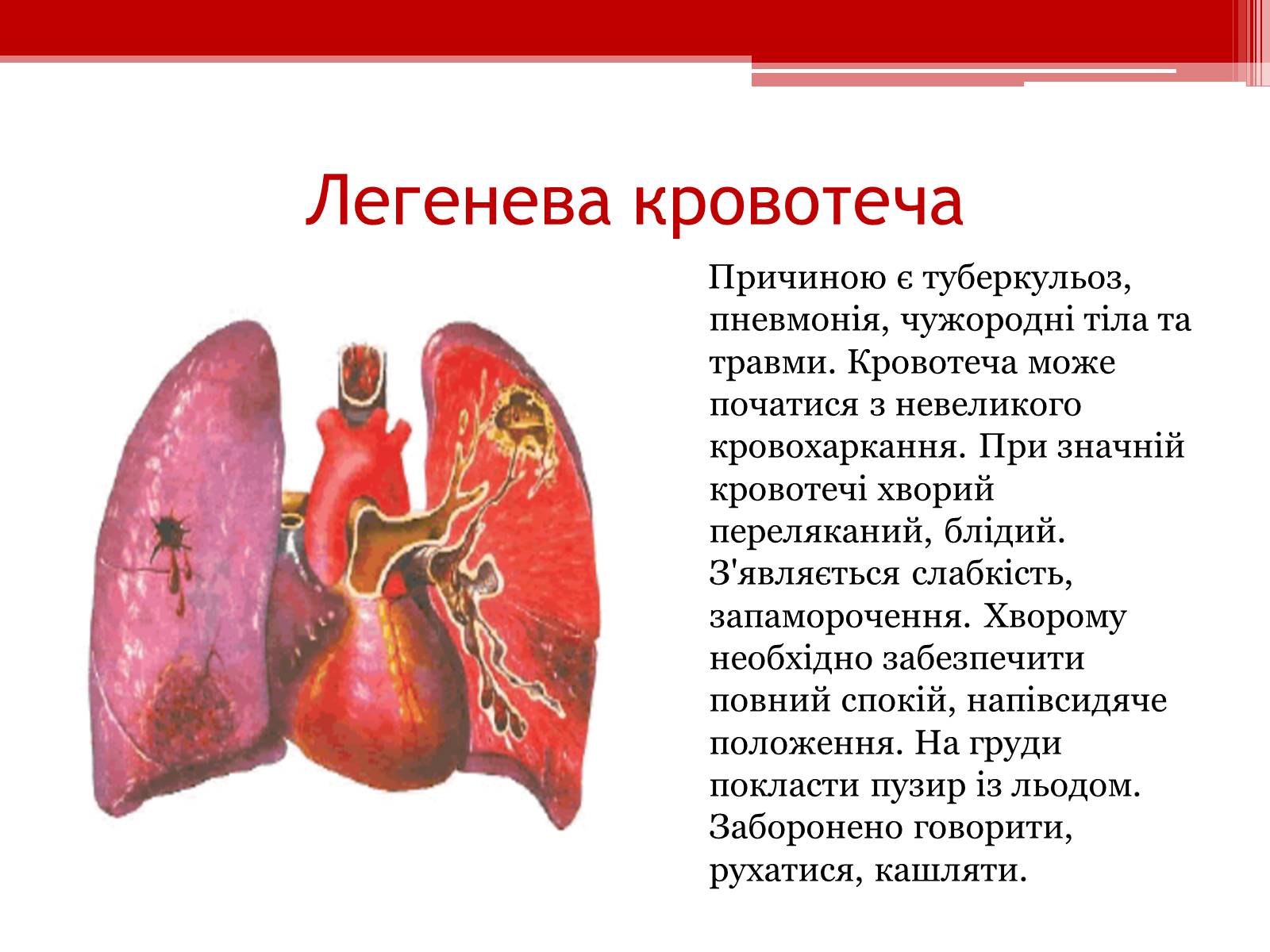 Презентація на тему «Перша допомога при кровотечах» (варіант 1) - Слайд #18