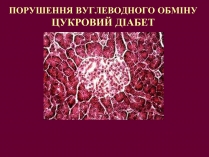 Презентація на тему «Цукровий діабет»