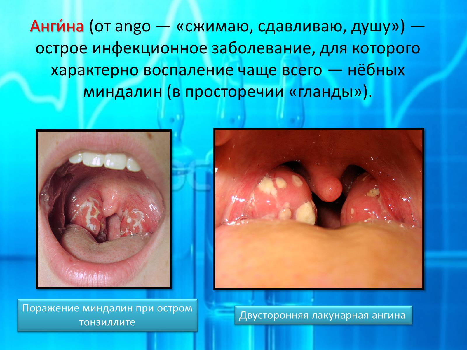 Презентація на тему «Ангина» - Слайд #1