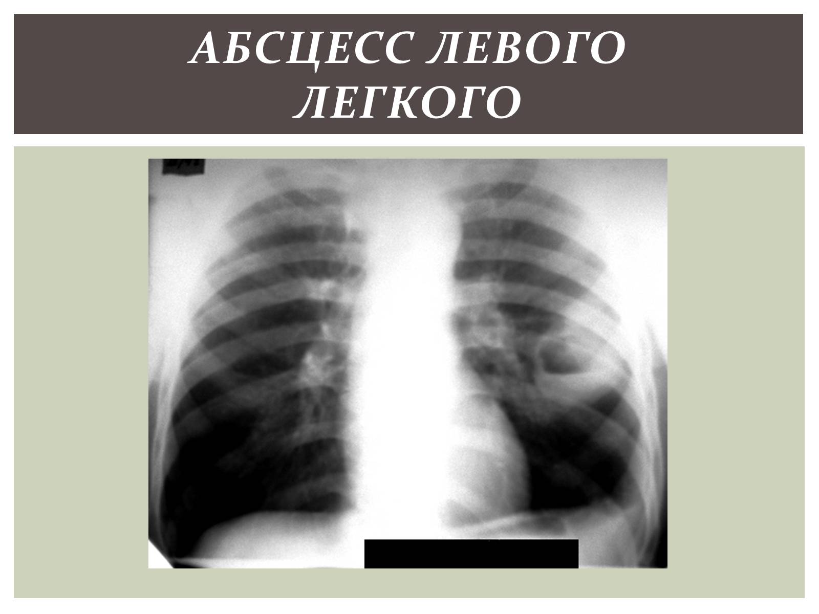 Презентація на тему «Абсцесс лёгкого» - Слайд #11