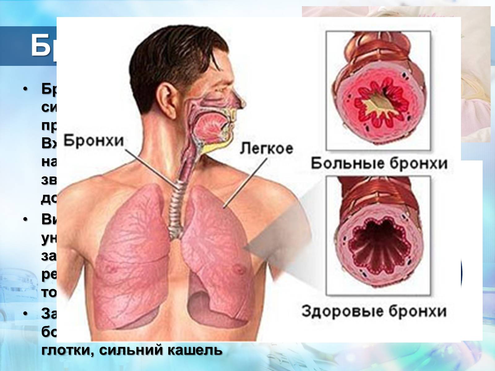 Презентація на тему «Захворювання дихальної системи. Бронхіт. Пневмонія. Астма» - Слайд #3