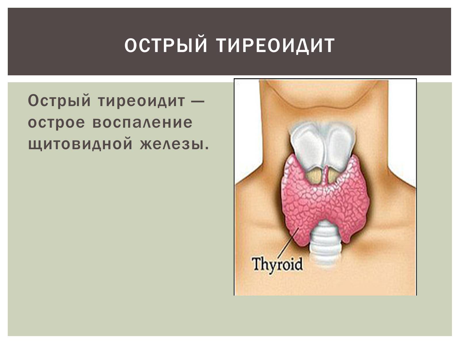 Аит щитовидной железы что это. Острый тиреоидит щитовидной железы. Тиреоидит щитовидной железы что это такое. Тиреомегалия щитовидной железы что это такое.