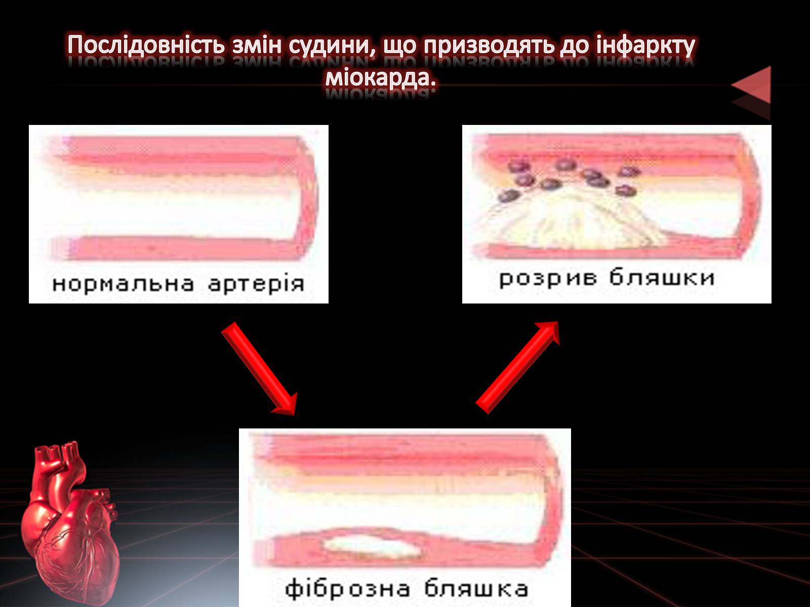 Презентація на тему «Методи відновлення кровообігу в уражених атеросклерозом коронарних артеріях при ішемічній хворобі серця» - Слайд #6