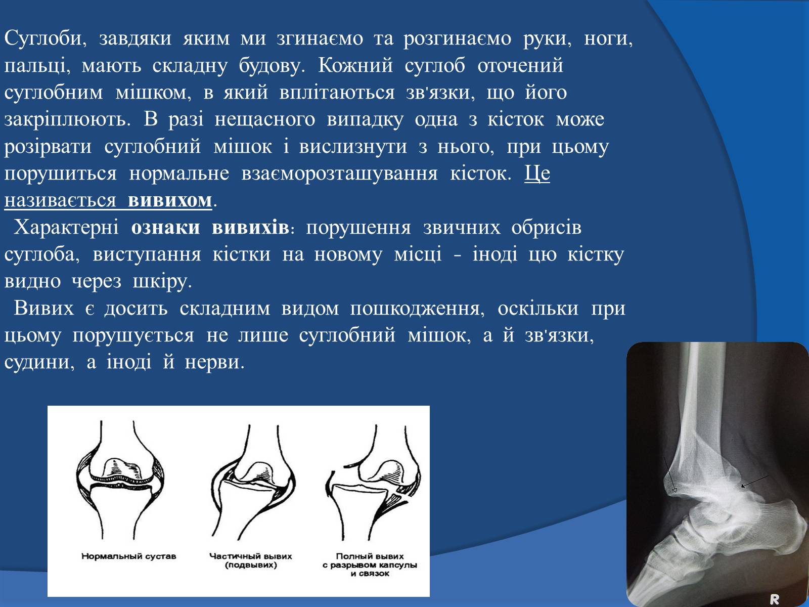 Презентація на тему «Травми кісток та суглобів» - Слайд #6