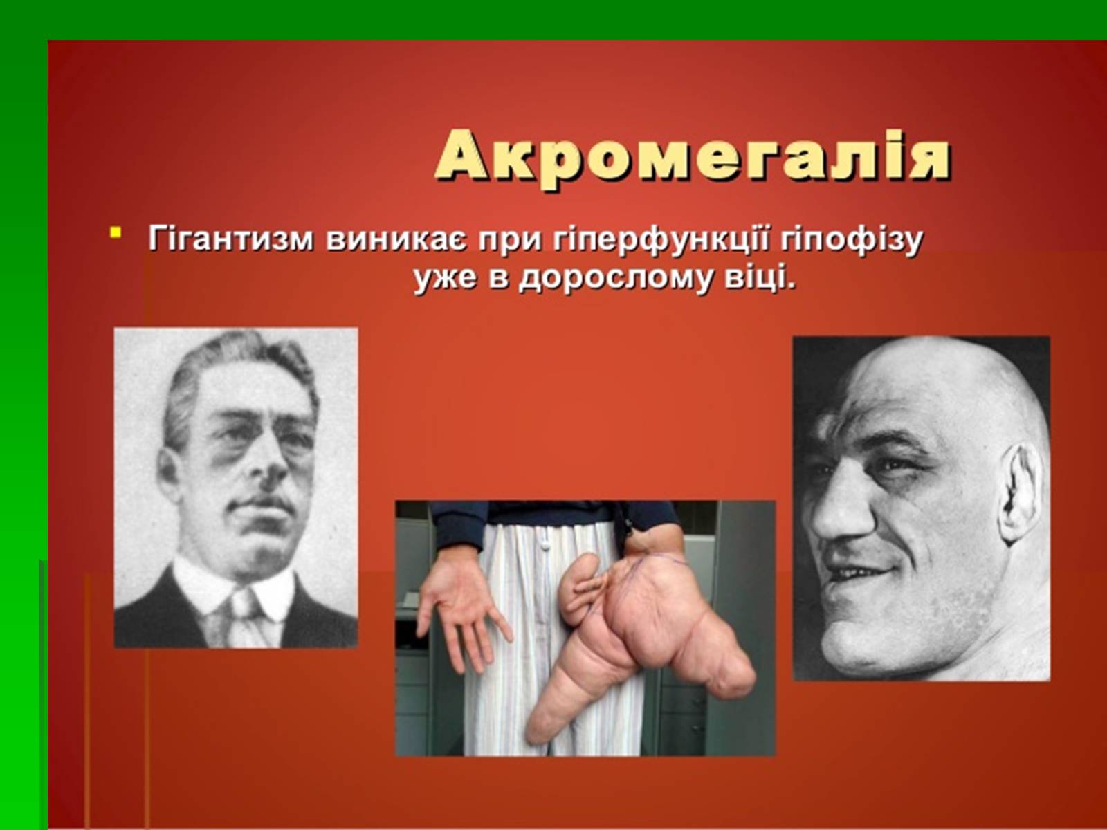 Презентація на тему «Захворювання залоз внутрішньої секреції» - Слайд #4