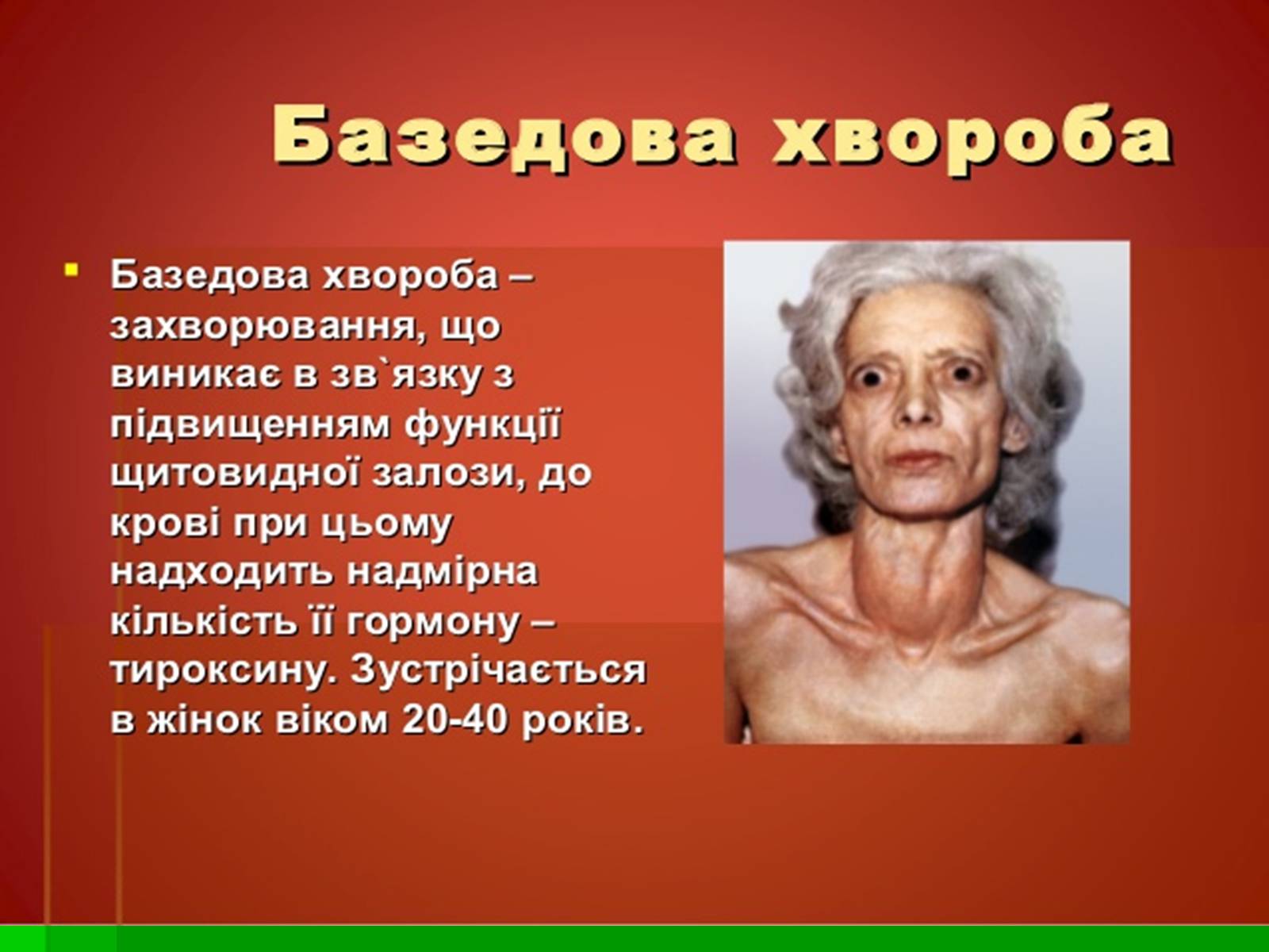 Презентація на тему «Захворювання залоз внутрішньої секреції» - Слайд #9