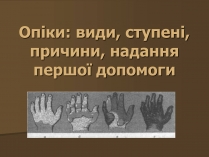 Презентація на тему «Опіки» (варіант 3)