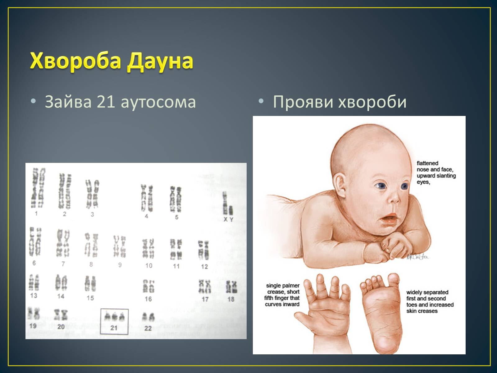 Презентація на тему «Типи генетичних хвороб людини» (варіант 2) - Слайд #15