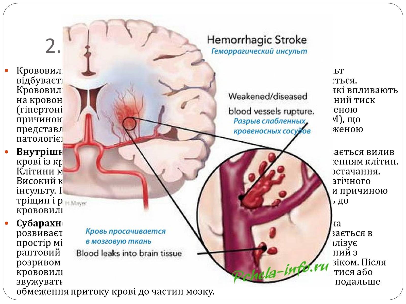 Был геморрагический инсульт. Этиология инсульта. Геморрагический инсульт. Патогенез геморрагического инсульта. Этиология геморрагического инсульта головного мозга.