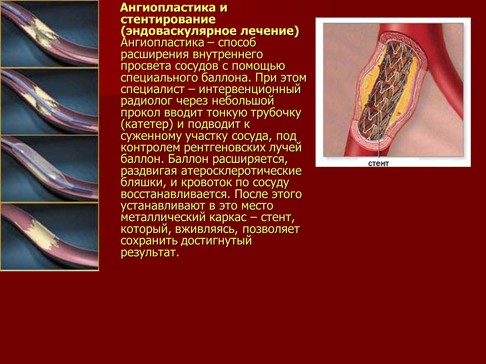 Ангиопластика