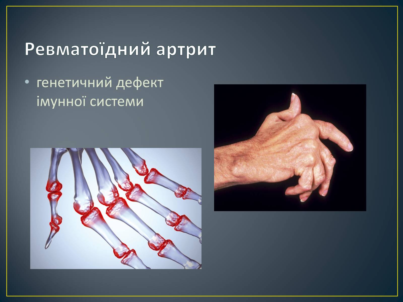 Презентація на тему «Типи генетичних хвороб людини» (варіант 1) - Слайд #11