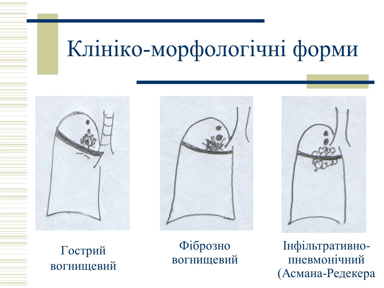 Презентація на тему «Патологічна анатомія туберкульозу» - Слайд #26