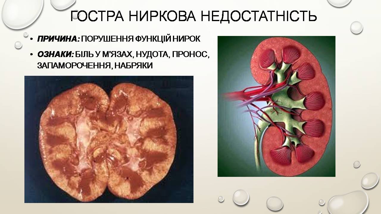 Презентація на тему «Перша допомога при захворюваннях шлунково-кишкового тракту та сечовивідної системи» - Слайд #11