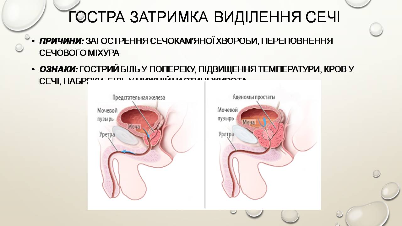 Презентація на тему «Перша допомога при захворюваннях шлунково-кишкового тракту та сечовивідної системи» - Слайд #15