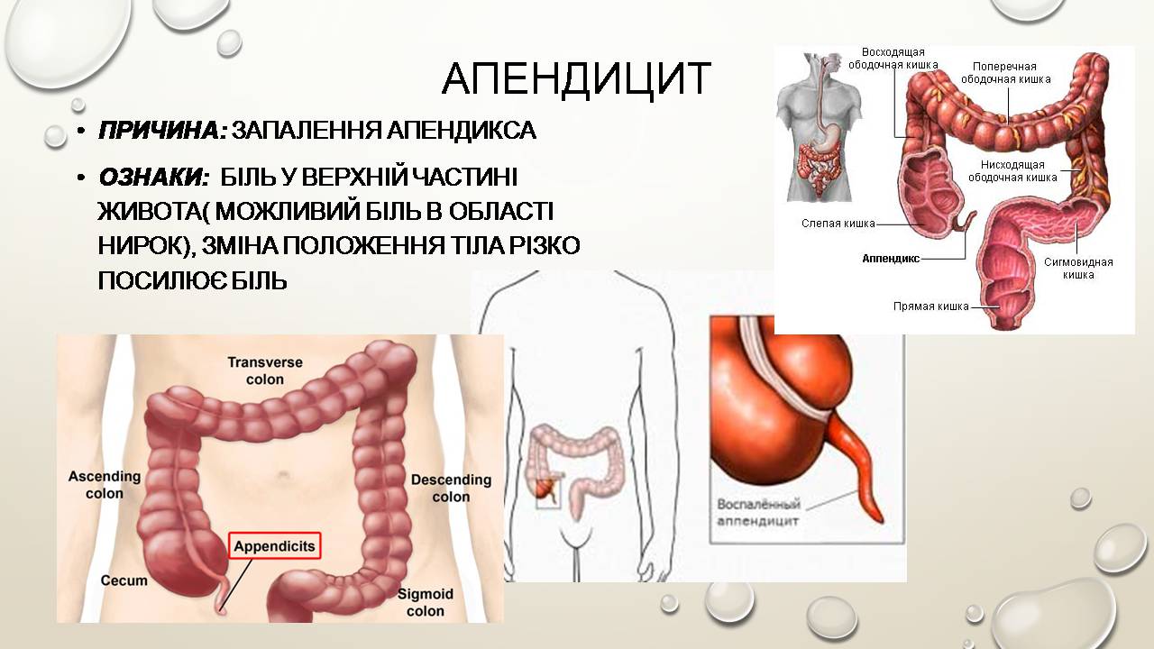 Боли в нисходящей ободочной кишки