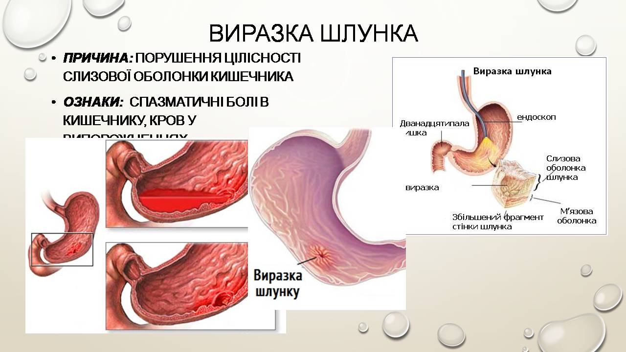 Презентація на тему «Перша допомога при захворюваннях шлунково-кишкового тракту та сечовивідної системи» - Слайд #5