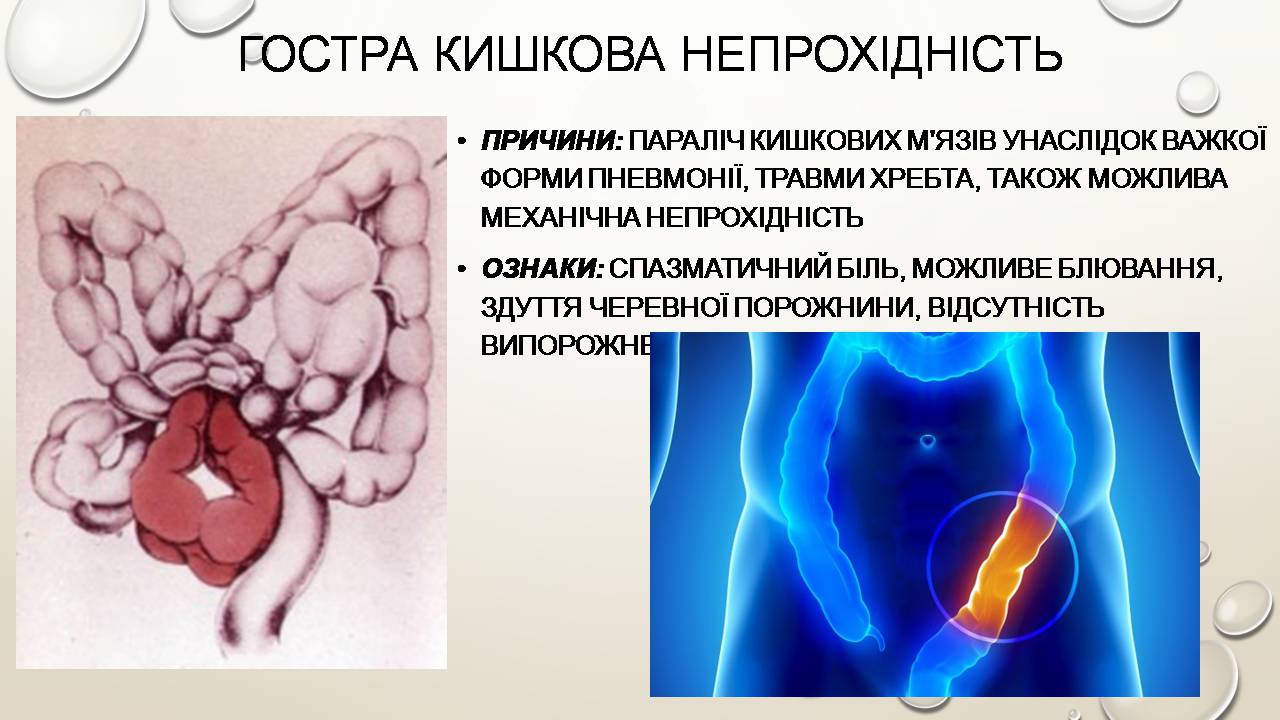 Презентація на тему «Перша допомога при захворюваннях шлунково-кишкового тракту та сечовивідної системи» - Слайд #6