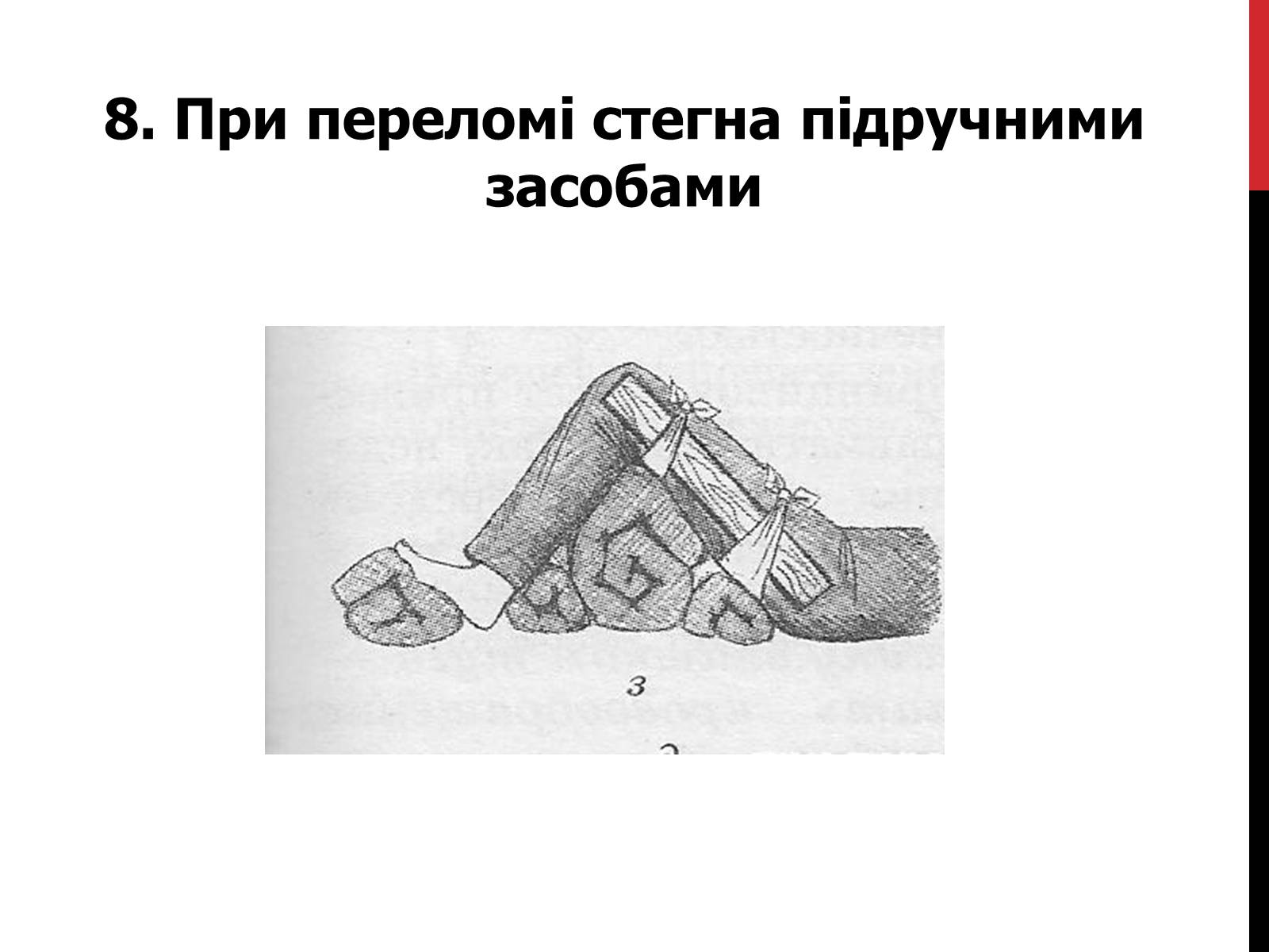 Презентація на тему «Іммобілізація верхніх та нижніх кінцівок» - Слайд #15