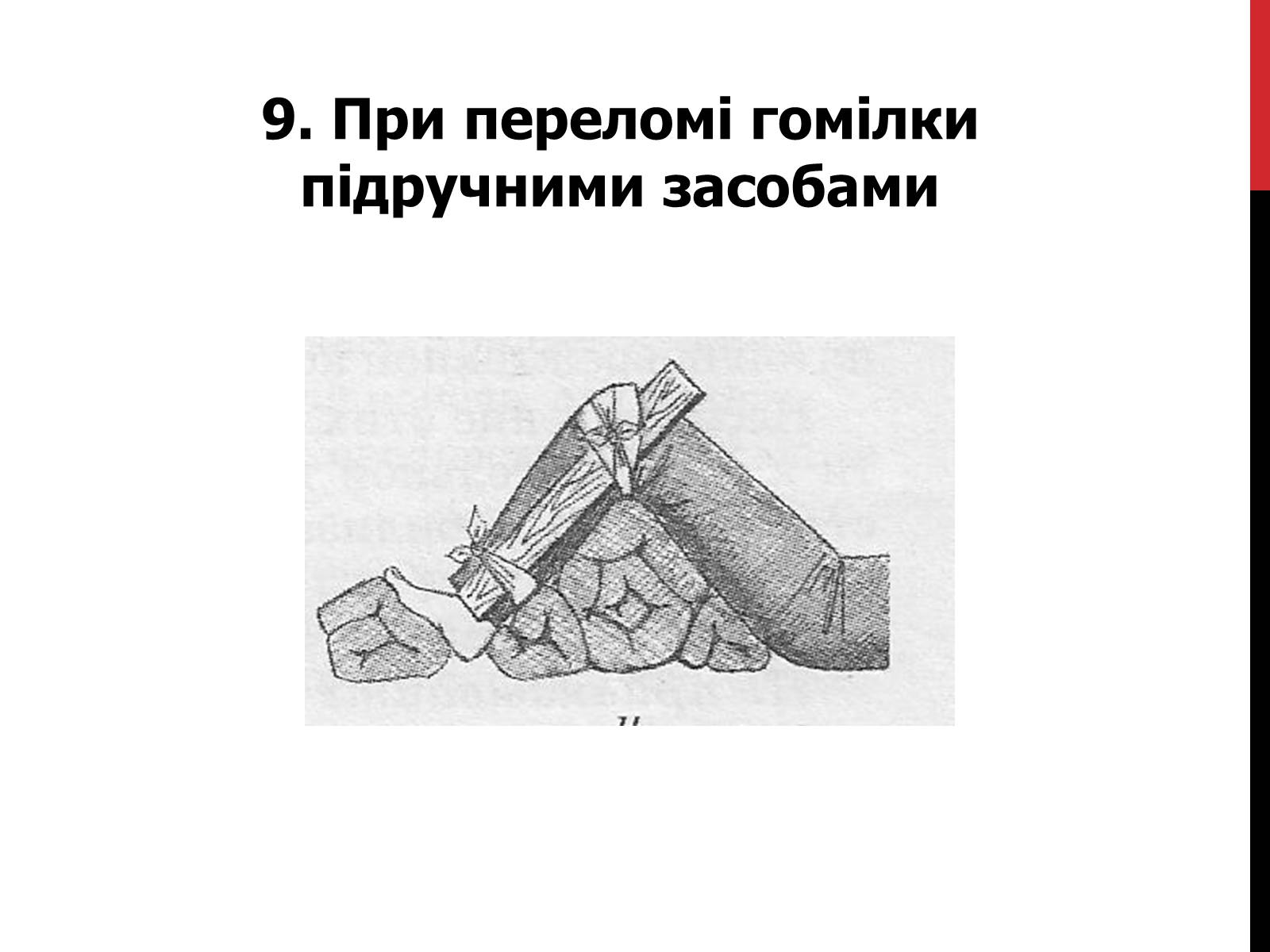 Презентація на тему «Іммобілізація верхніх та нижніх кінцівок» - Слайд #16